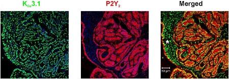 Multiplex staining of KCa3.1 and P2Y2 in human ovarian carcinoma